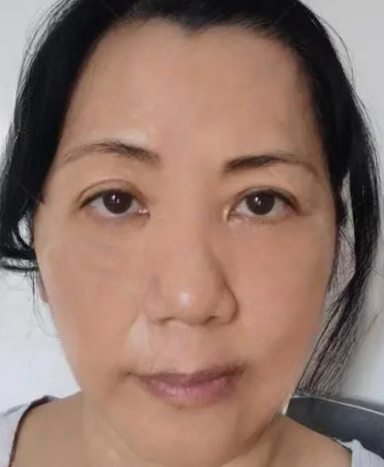 去眼袋手术