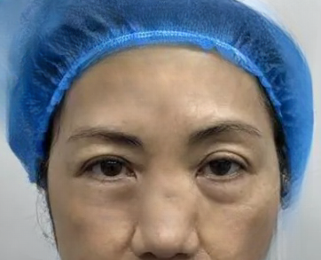 去眼袋手术