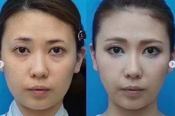 去眼袋手术