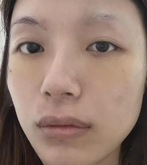 去眼袋手术