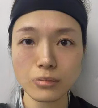去眼袋手术
