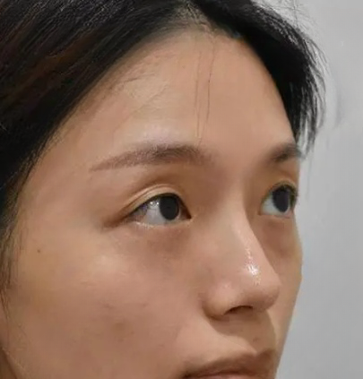 去眼袋手术