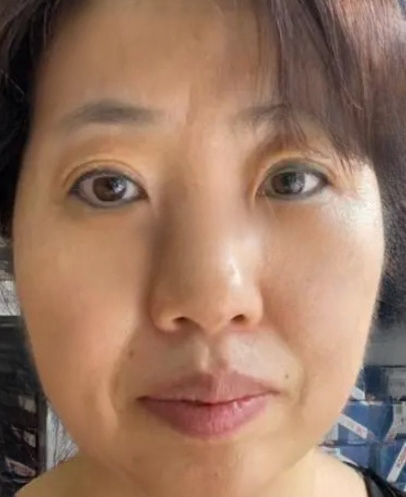 去眼袋手术