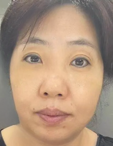 去眼袋手术