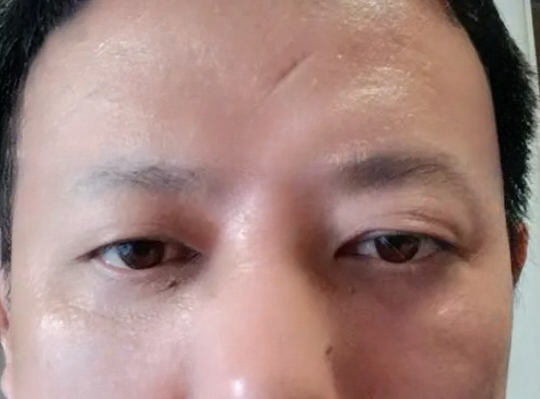 去眼袋手术