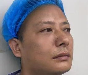 去眼袋手术
