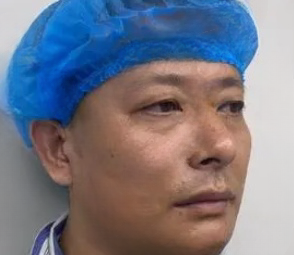 去眼袋手术