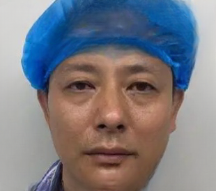 去眼袋手术
