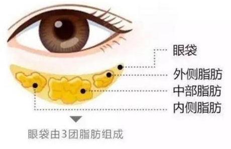 去眼袋手术