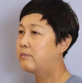 去眼袋手术