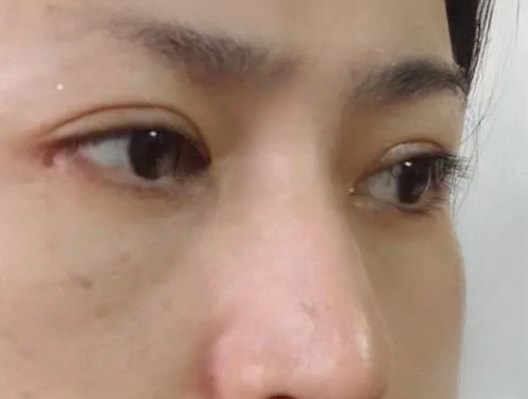 去眼袋手术