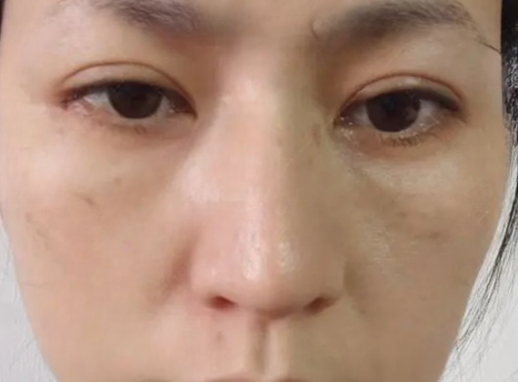 去眼袋手术