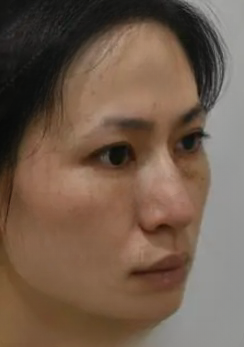 去眼袋手术