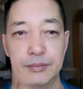 去眼袋手术