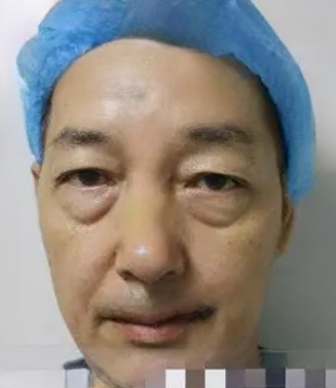 去眼袋手术
