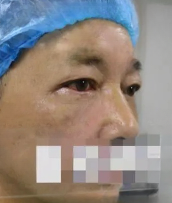 去眼袋手术