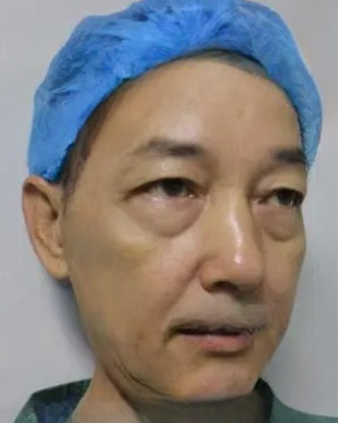 去眼袋手术