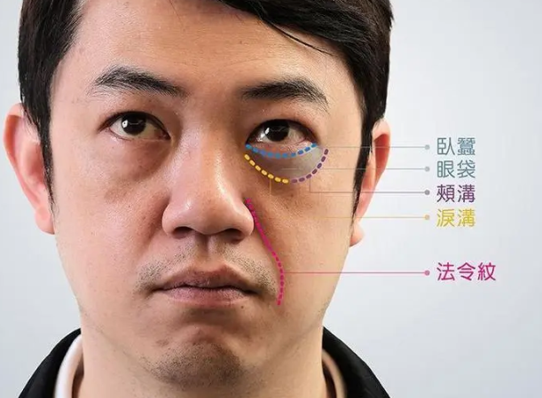 去眼袋手术