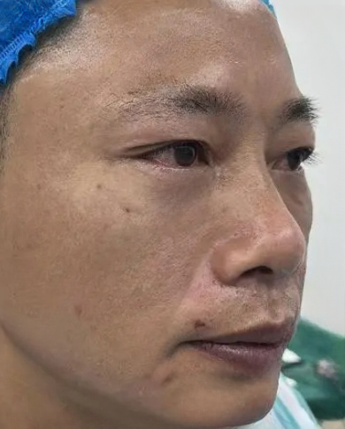 去眼袋手术