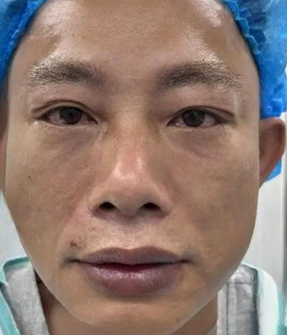 去眼袋手术