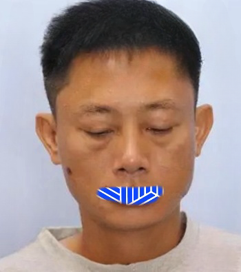 去眼袋手术