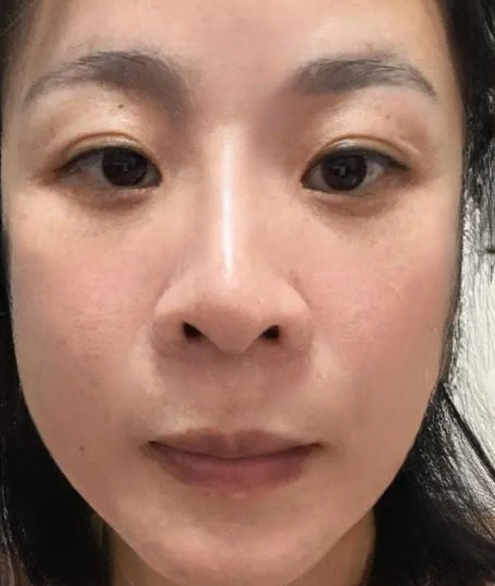 去眼袋手术