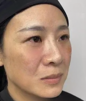 去眼袋手术