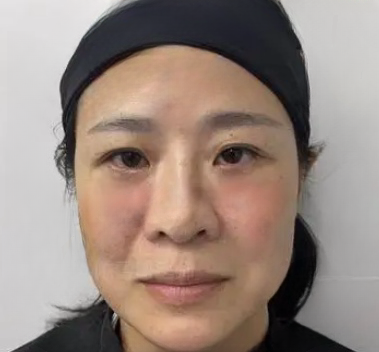 去眼袋手术
