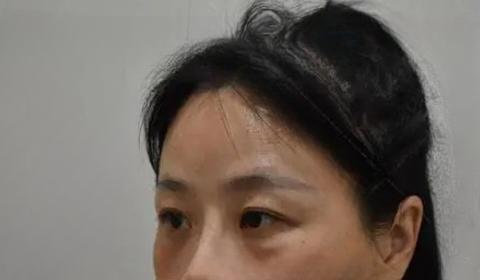 去眼袋手术