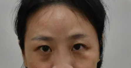 去眼袋手术