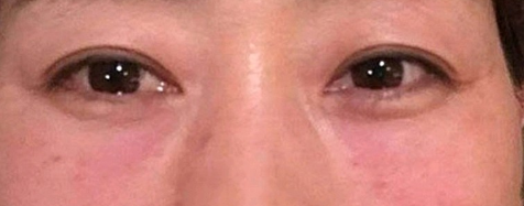 去眼袋手术