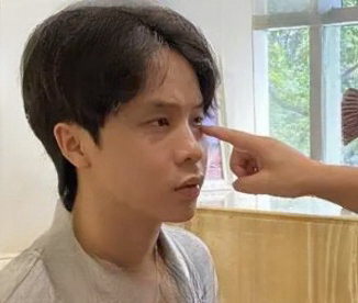 去眼袋手术