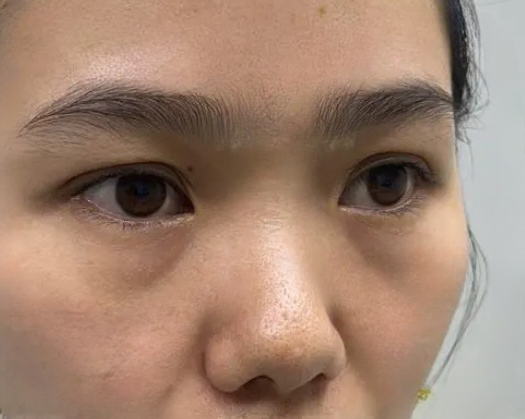 去眼袋手术