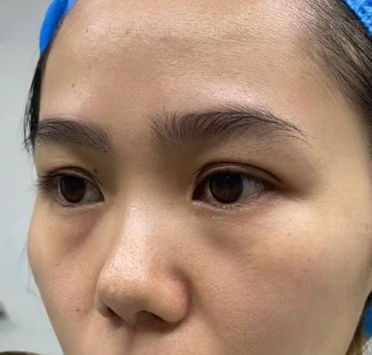 去眼袋手术