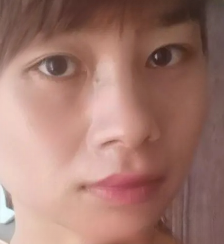 去眼袋手术