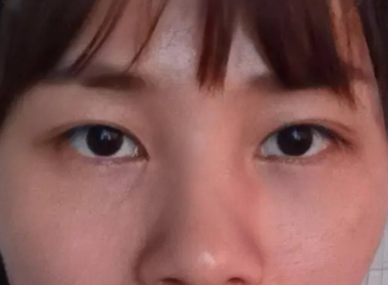 去眼袋手术