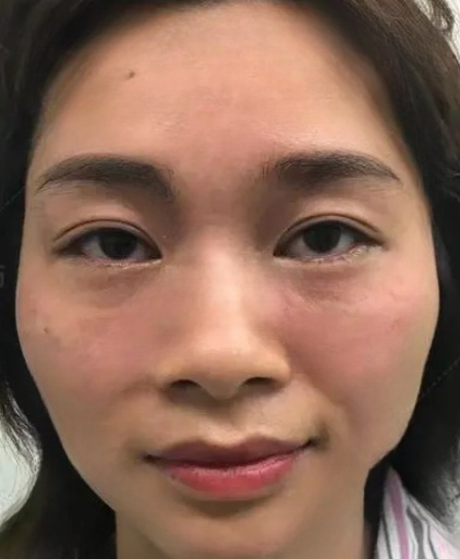 去眼袋手术