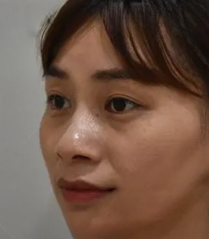 去眼袋手术