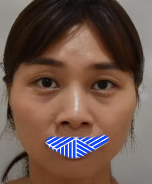 去眼袋手术