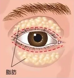 去眼袋手术