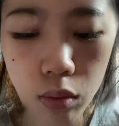 去眼袋手术