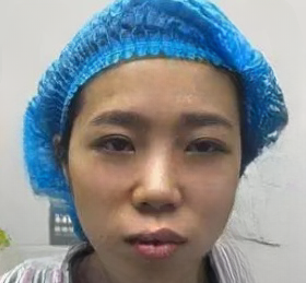 去眼袋手术