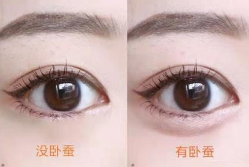 去眼袋手术