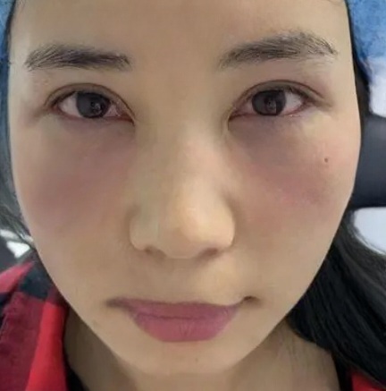 去眼袋手术