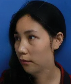 去眼袋手术