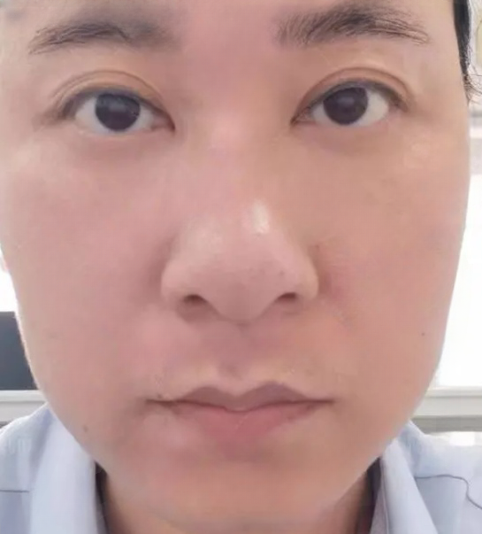 去眼袋手术