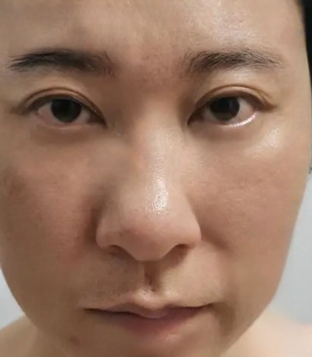去眼袋手术