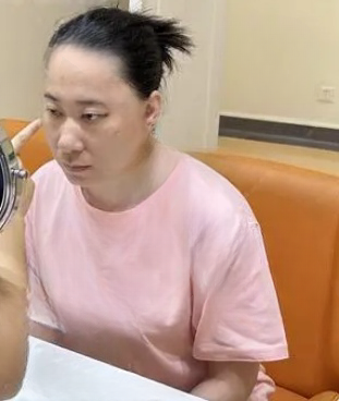 去眼袋手术