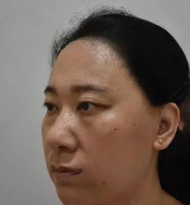 去眼袋手术