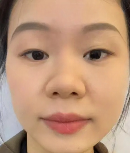 去眼袋手术